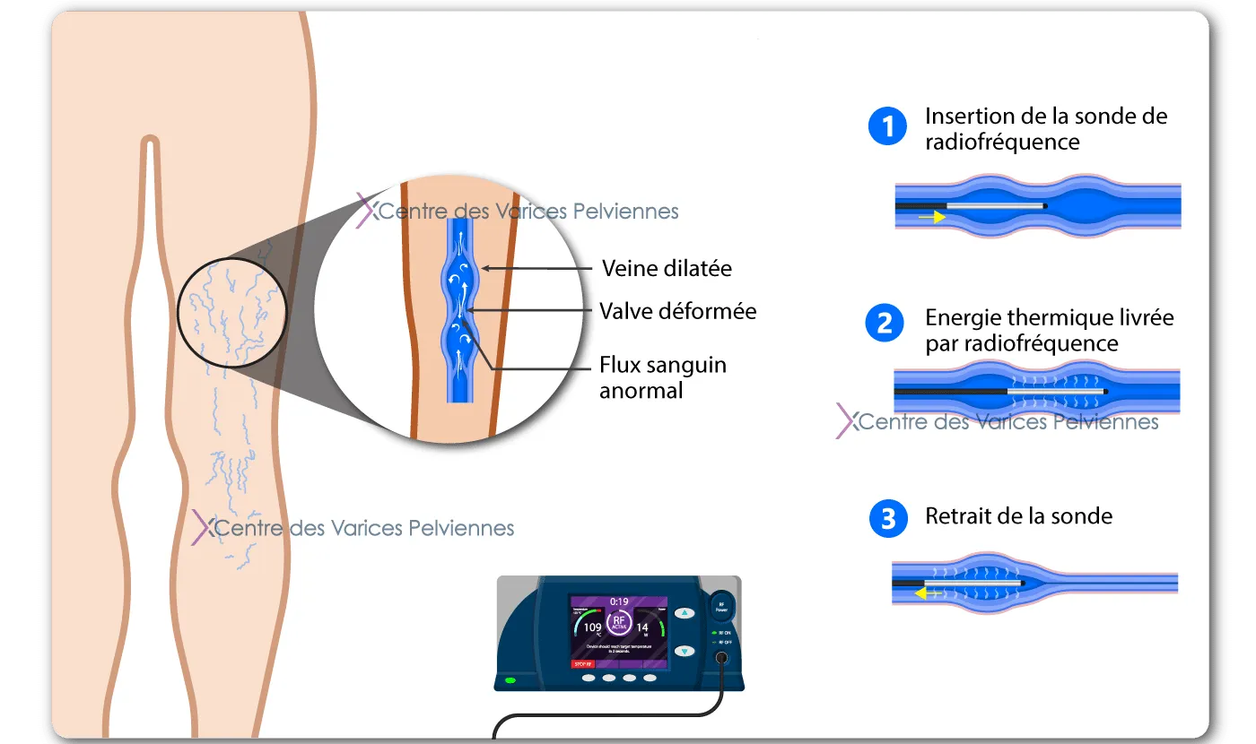 Varices des jambes Traitement Centre des Varices Pelviennes